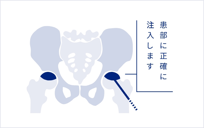 患部(骨内)に正確に注入します